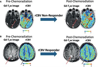 Paradoxical Association Between Relative Cerebral Blood Volume Dynamics Following Chemoradiation and Increased Progression-Free Survival in Newly Diagnosed IDH Wild-Type MGMT Promoter Methylated Glioblastoma With Measurable Disease